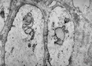 M,1y. | neuroblastoma - submandibular region M,1y. | neuroblastoma - submandibular region